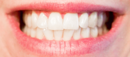 dental patient after scaling