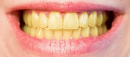 dental patient before scaling