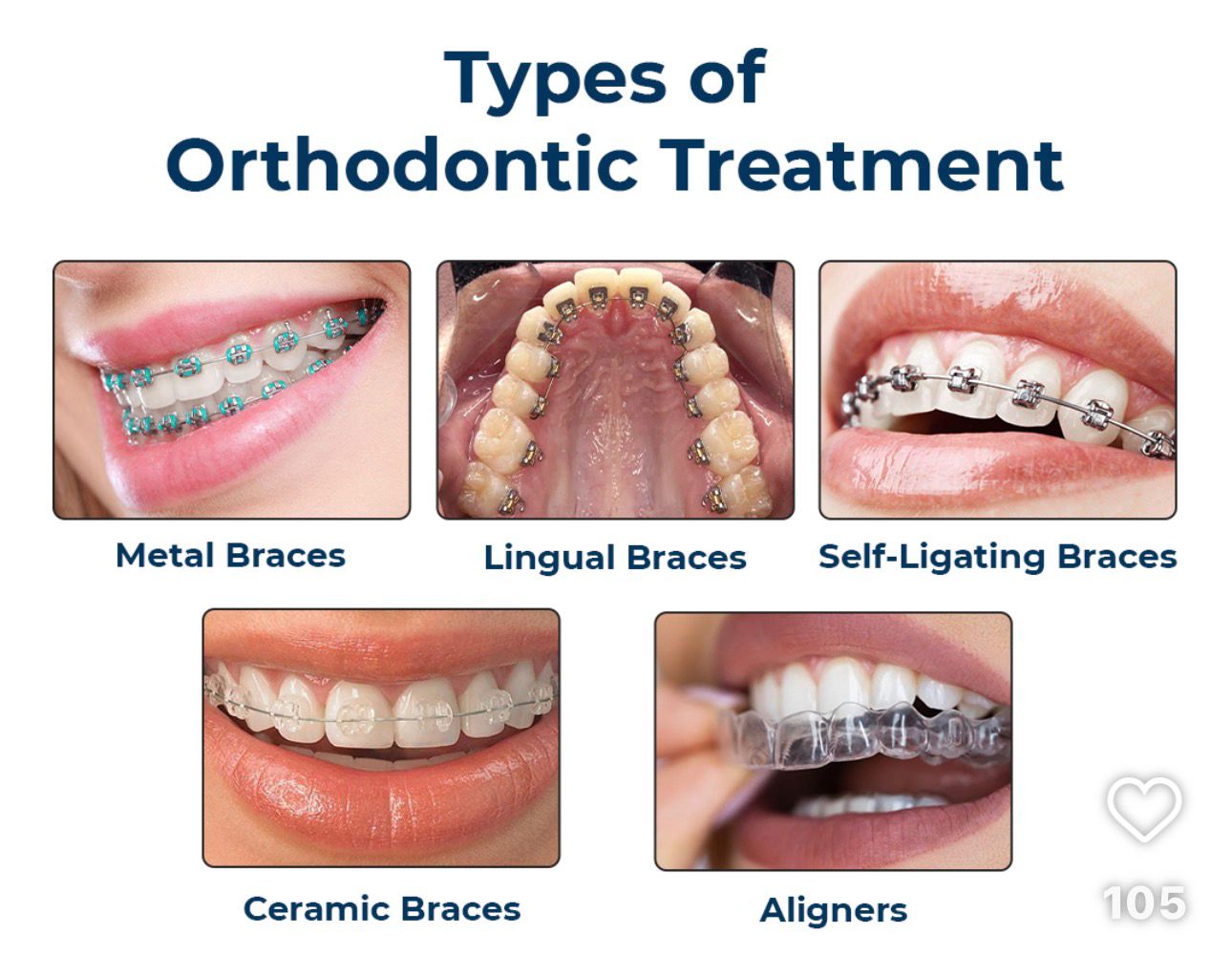 Clear Aligners vs Braces – Which Is Right for You? Clear Aligners vs Braces – Which Is Right for You?